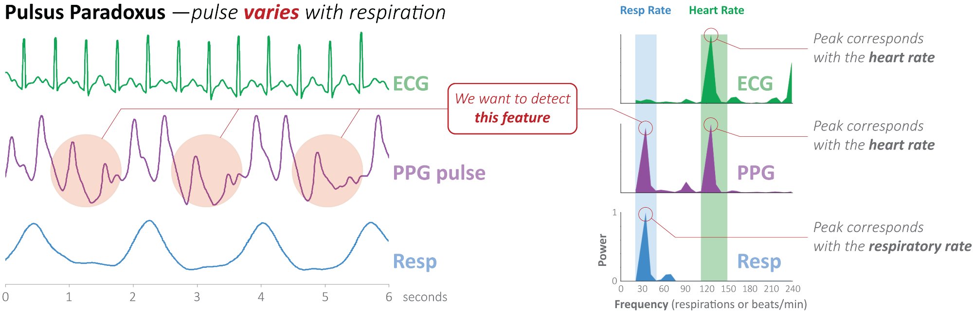 Pulsus paradoxus: time domain waveforms and power spectrum showing pulse varying with respiration