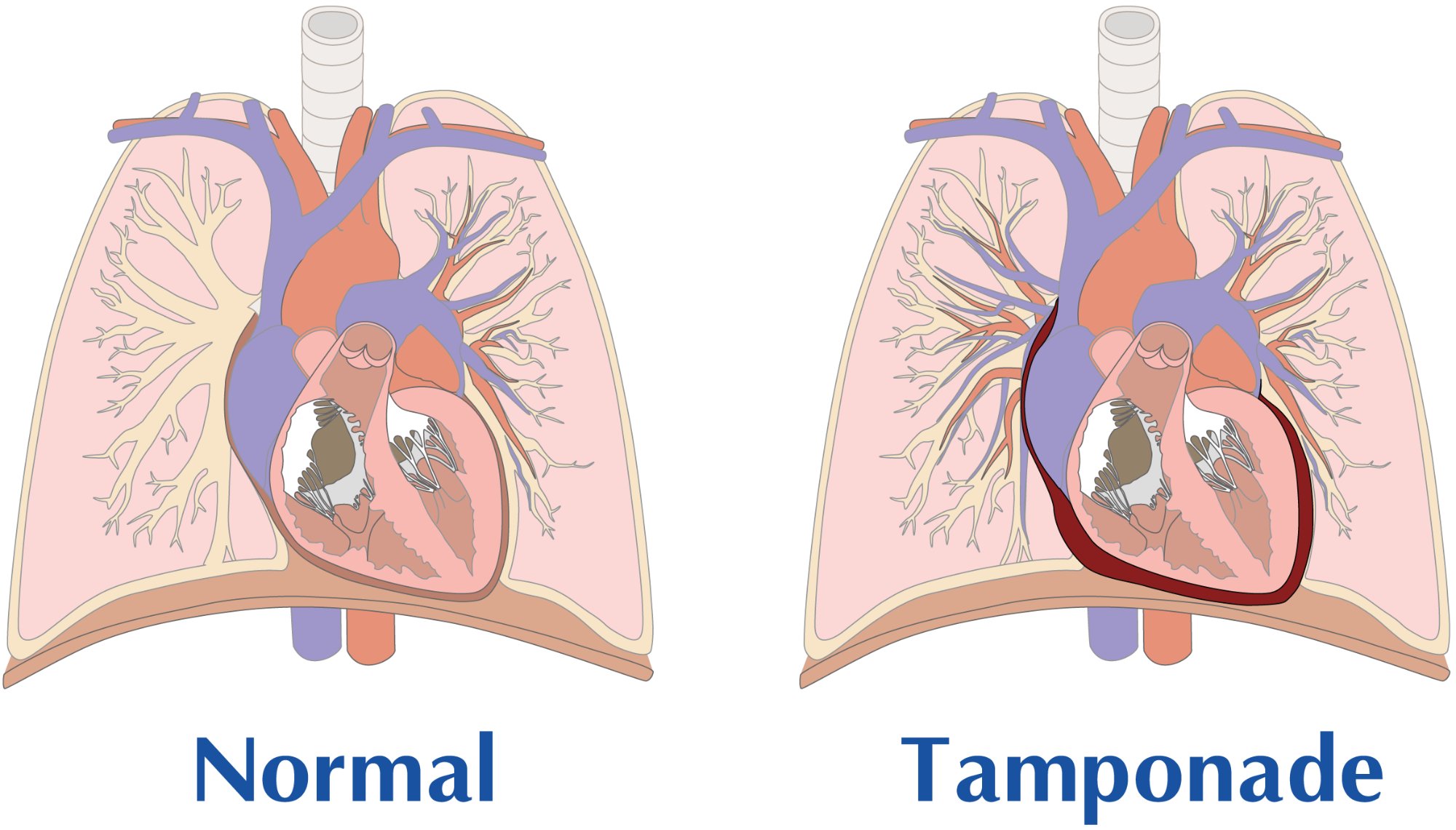 Comparison of normal heart vs cardiac tamponade showing fluid compression in the pericardial space